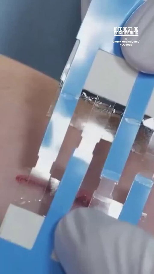 No Need for Stitches: Device Seals Wounds with Adhesive Precision
by @IntEngineering
 
#MedTech #HealthTech #TechForGood #Tech 