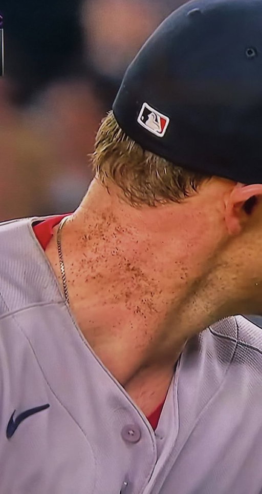 Completely normal to have on your neck when you pitch 