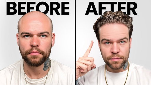 I Got A Turkish Hair Transplant! Before, During and After