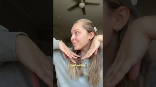 One week post microneedling at skin pharm and obsessed!!! My light acne scarring looks so much