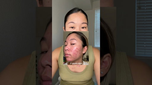 the skincare routine that transformed my skin 😌 #acne #skincareroutine #skincare #acnetreatment