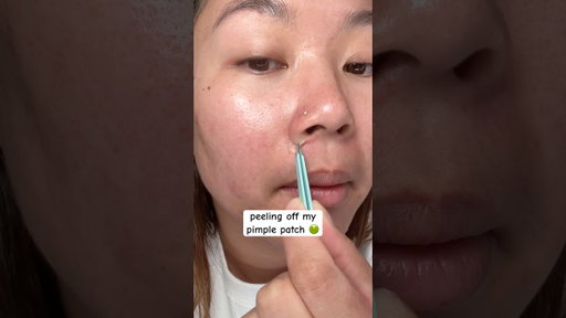 i havent had a super juicy peel in a while 🫣 #pimplepatch #acne #skincare