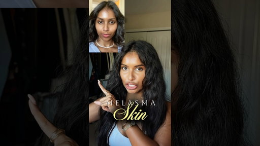 Melasma vs Hyperpigmentation