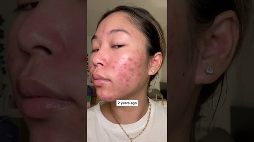 my acne 2 yrs ago vs now 🥹 #acne #skincare #skin