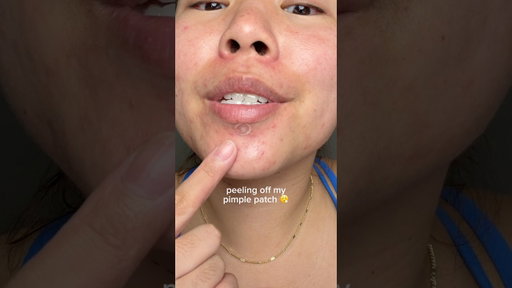 peeling off my juicy pimple patch 😮‍💨 #acne #pimplepatch #skincare #acneskincare