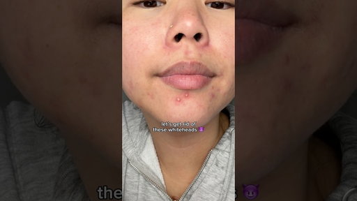 wow those were some juicy pimple patch peels 🤩 #acne #pimplepatch #skincare #pimplepopping