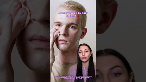 Common acne myths and the REAL causes of acne!