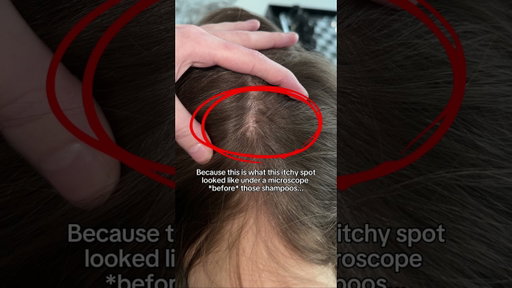 Head & Shoulders and Nizoral saved my scalp…