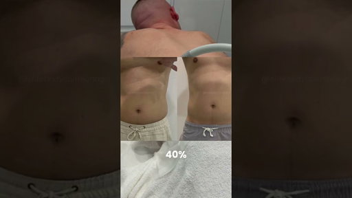 Fat Freezing for Men
