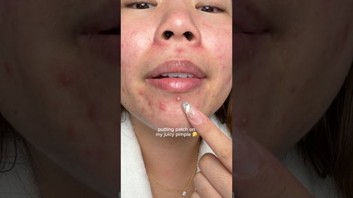 patching up my juicy pimple 🤧 #skincare #pimplepatch #acne #skincareroutine #skin