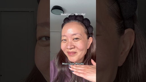 Moxi laser results! Great for melasma, dark spots & texture. #moxilaser #melasmatreatment #darkspots