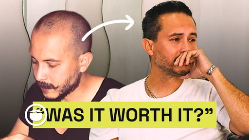 How a Hair Transplant Changed My Life | My Transformation