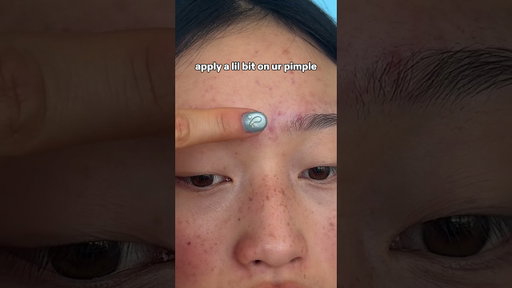 NEW STAR TREATMENT 🩵 plz give it up for this max strength 2% salicylic acid acne spot treatment !!