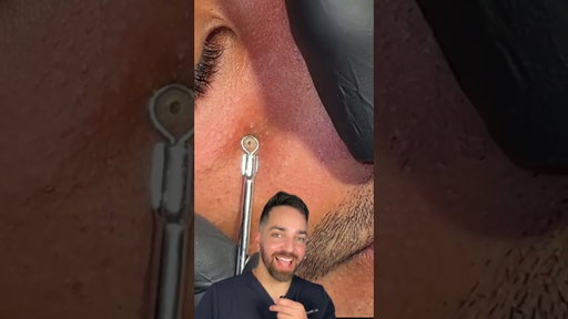Derm Reacts to Giant Blackhead
