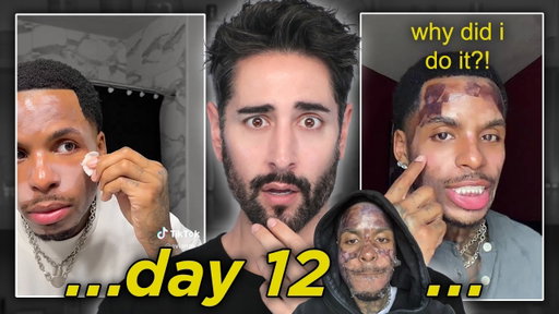 The TIKTOK DIY 30% Chemical Peel….GONE WRONG 😭