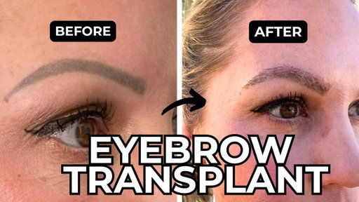 I Got an Eyebrow Transplant: My Honest Experience