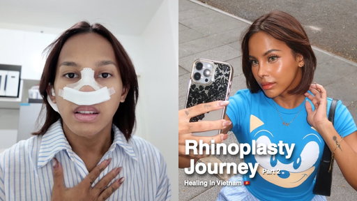RHINOPLASTY JOURNEY (PART 2) | AWRA BRIGUELA