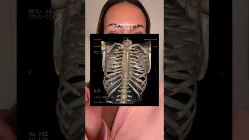 getting my ribs REMOVED?! jk 💀 just getting ribxcar and im so excited 💕 #glowup #plasticsurgery
