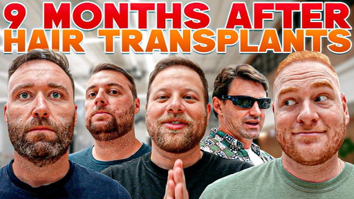 I Helped Them Get Hair Transplants… Here’s What They Look Like Now! | BALDSTOOL REUNION
