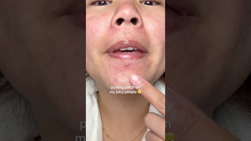 putting a pimple patch on my whitehead 😮‍💨 #skincare #acne #pimplepatch #pimple