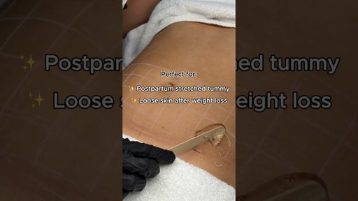 Loose Skin? HIFU Body Can Help — Reel