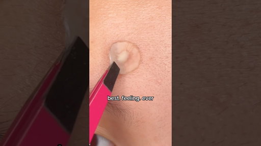 Juicy pimple patch removal😮‍💨