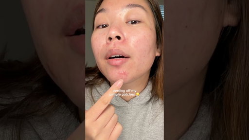 peeling off my pimple patches 🤧 #acne #skincare #skincareroutine #pimplepatch #koreanskincare